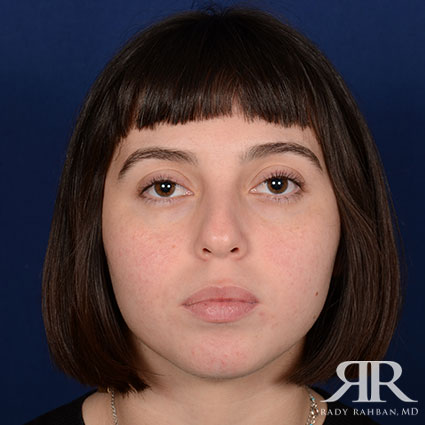 Female Rhinoplasty