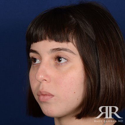 Female Rhinoplasty