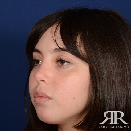 Female Rhinoplasty