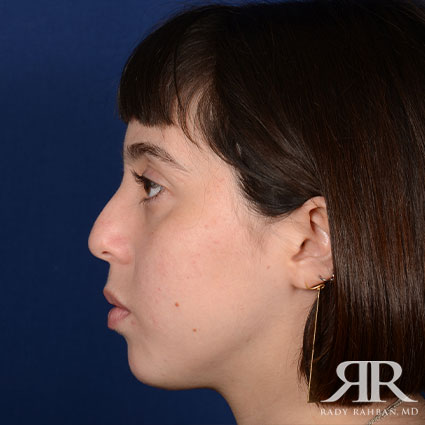 Female Rhinoplasty