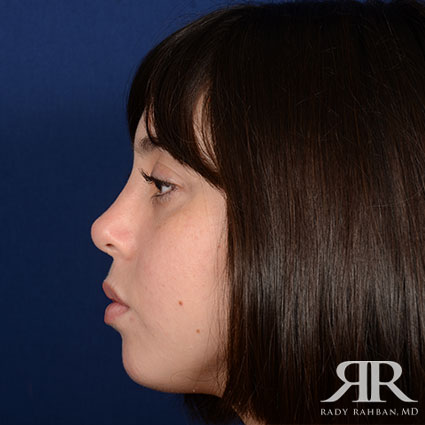 Female Rhinoplasty