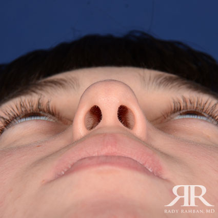 Female Rhinoplasty