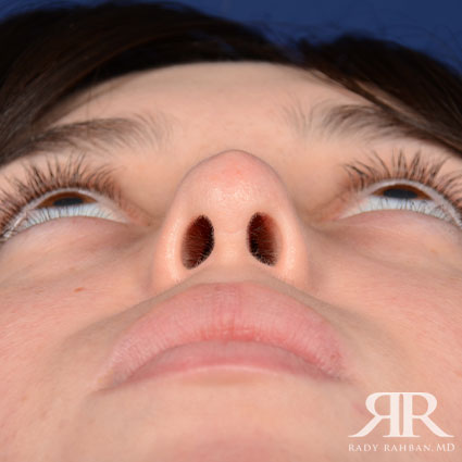 Female Rhinoplasty