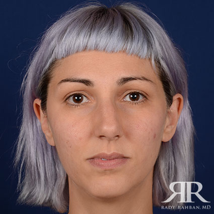 Female Rhinoplasty