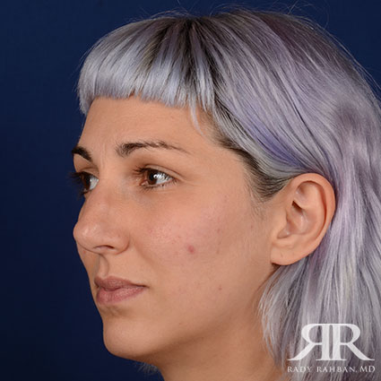 Female Rhinoplasty