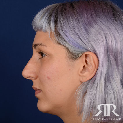 Female Rhinoplasty