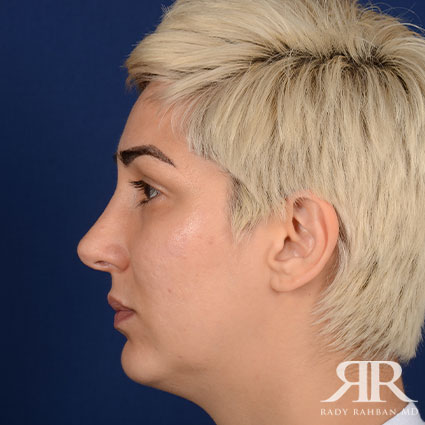 Female Rhinoplasty