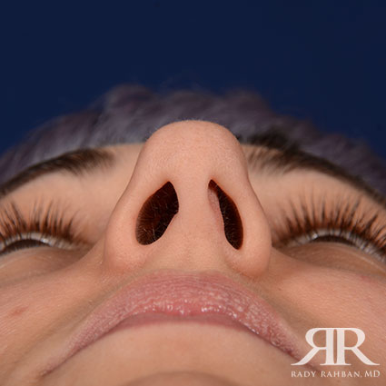 Female Rhinoplasty