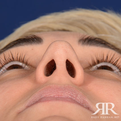 Female Rhinoplasty