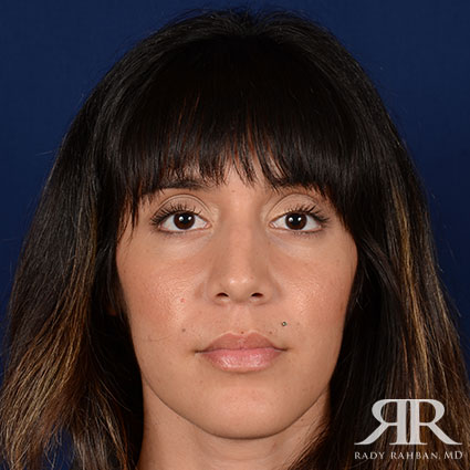 Female Rhinoplasty