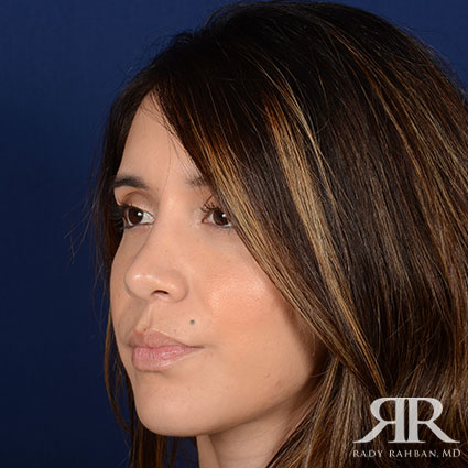 Female Rhinoplasty