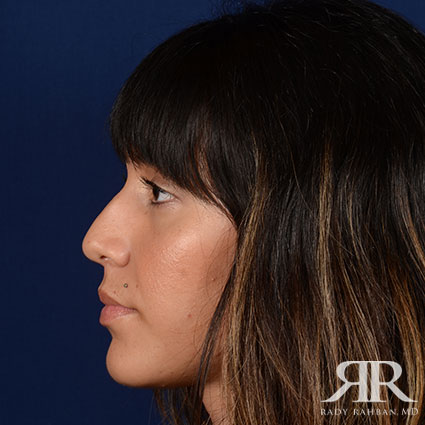 Female Rhinoplasty