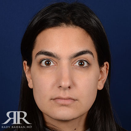 Female Rhinoplasty