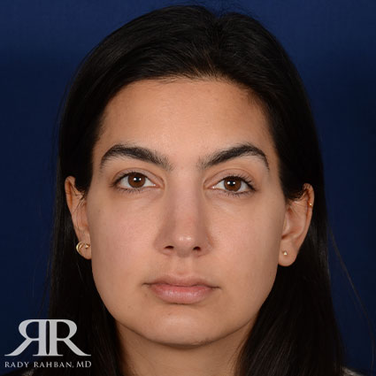 Female Rhinoplasty