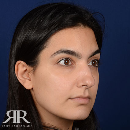 Female Rhinoplasty