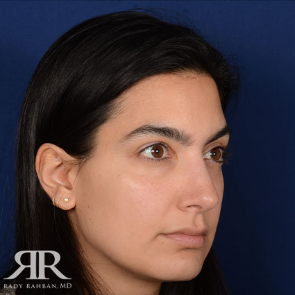 Female Rhinoplasty