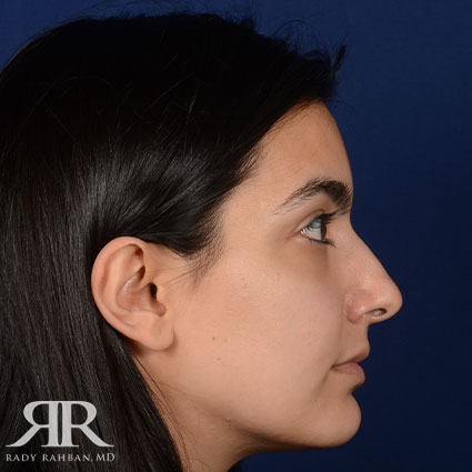 Female Rhinoplasty