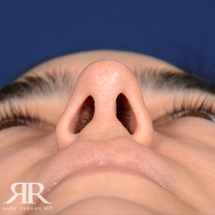 Female Rhinoplasty