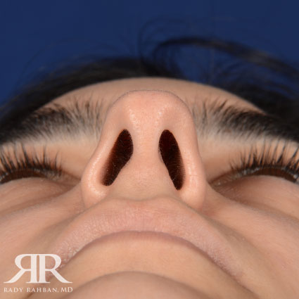 Female Rhinoplasty