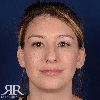 Female Rhinoplasty