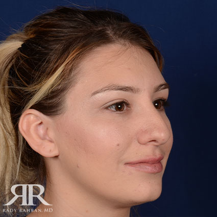 Female Rhinoplasty