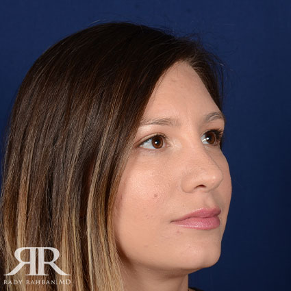 Female Rhinoplasty