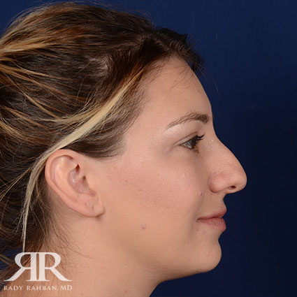 Female Rhinoplasty