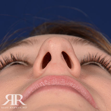 Female Rhinoplasty