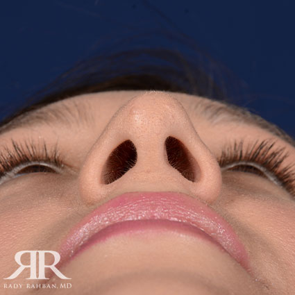 Female Rhinoplasty