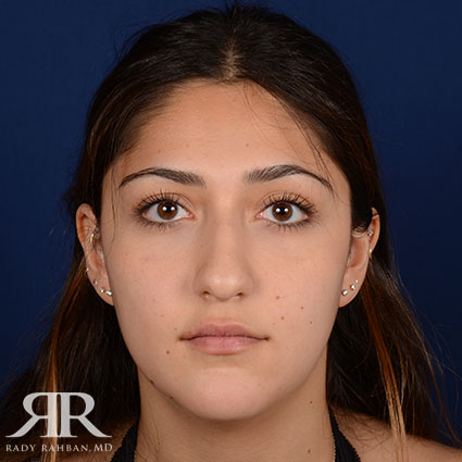 Female Rhinoplasty