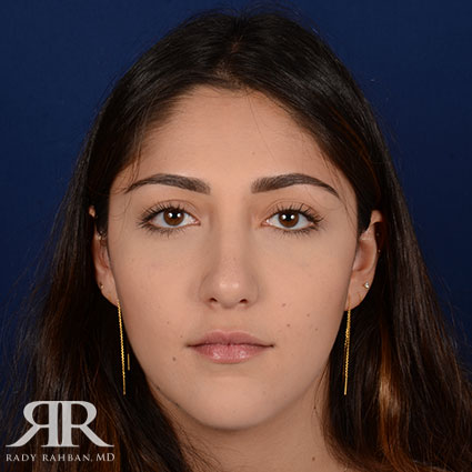 Female Rhinoplasty