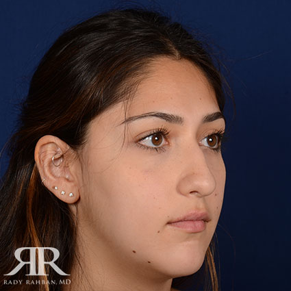Female Rhinoplasty