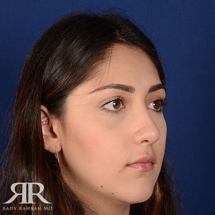 Female Rhinoplasty