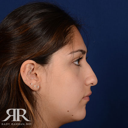 Female Rhinoplasty