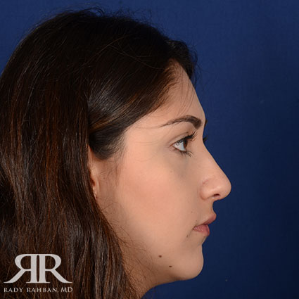 Female Rhinoplasty