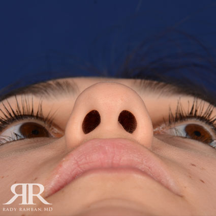 Female Rhinoplasty