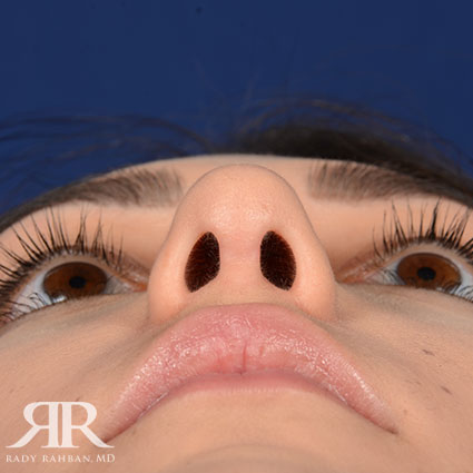 Female Rhinoplasty