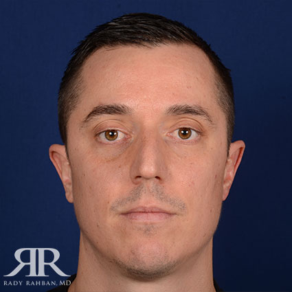 Male Rhinoplasty