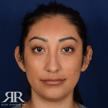 Rhinoplasty w/ Chin Implant