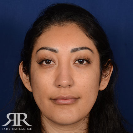 Rhinoplasty w/ Chin Implant