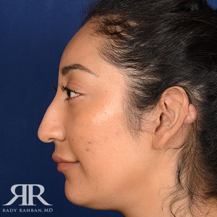 Rhinoplasty w/ Chin Implant