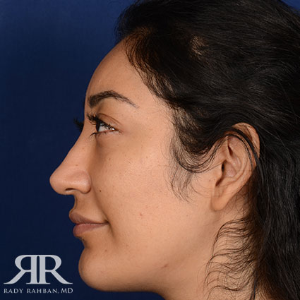 Rhinoplasty w/ Chin Implant