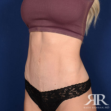 Tummy Tuck