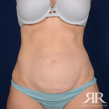 Tummy Tuck