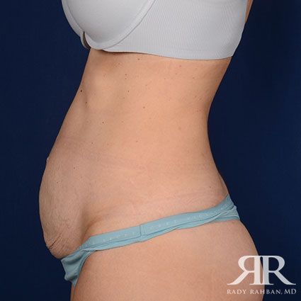 Tummy Tuck