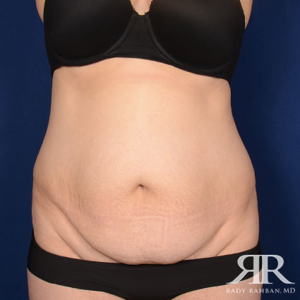 Tummy Tuck