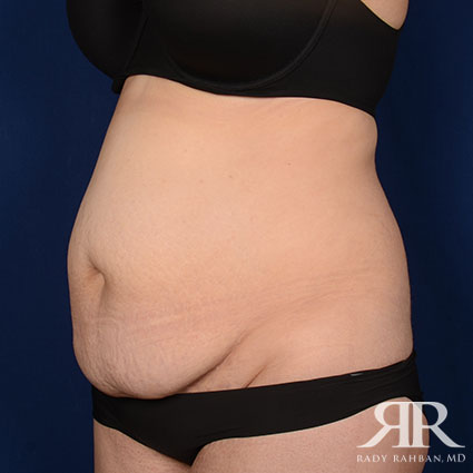 Tummy Tuck