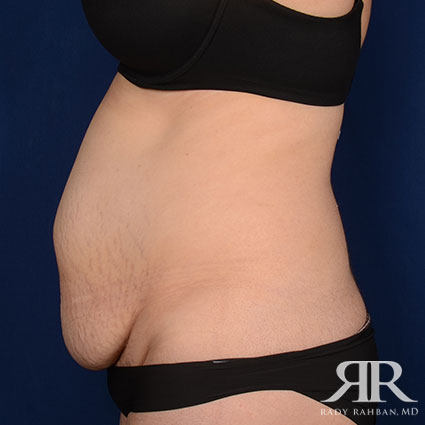 Tummy Tuck