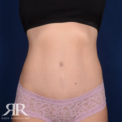 Tummy Tuck