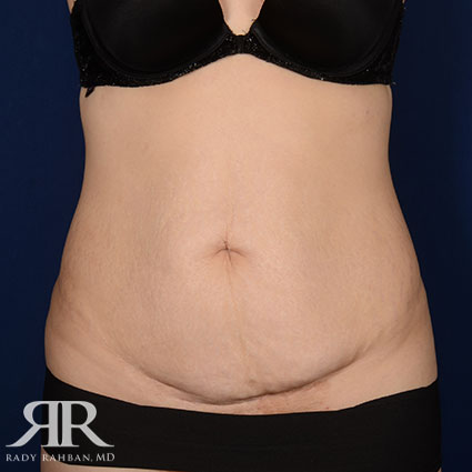 Tummy Tuck